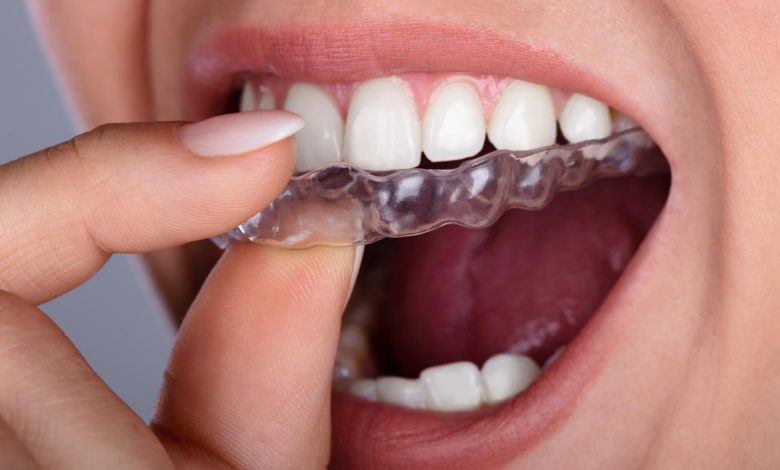 Invisalign Cost Cardiff