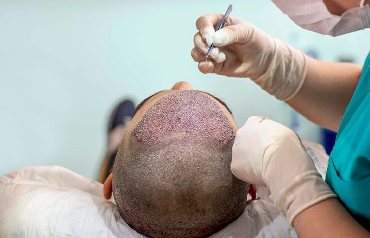 أفضل زراعة شعر في دبي